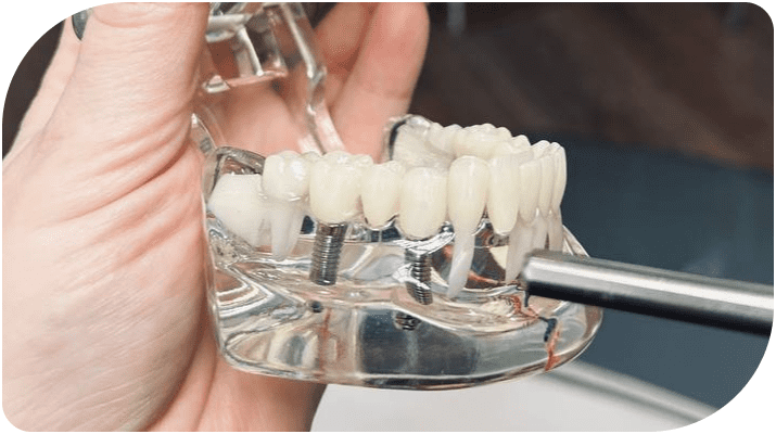 Имплантация челюсти при полном отсутствии зубов